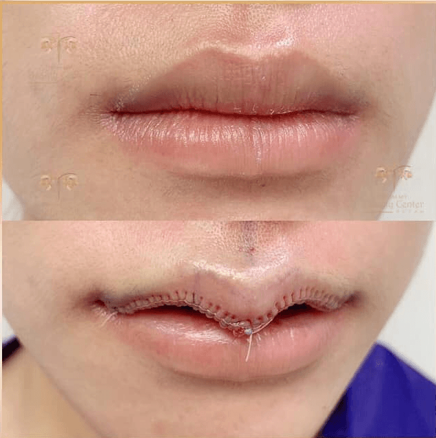 Thẩm mỹ môi