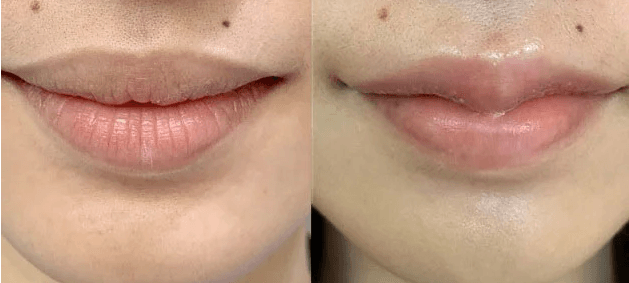 Thẩm mỹ môi