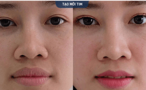 Thẩm mỹ môi