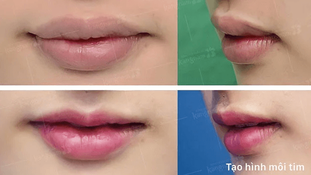 Thẩm mỹ môi