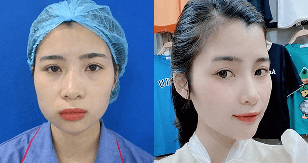 Sửa cằm vẹo, lỗi do phẫu thuật