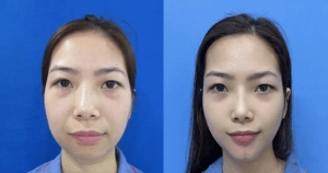 Sửa cằm vẹo, lỗi do phẫu thuật