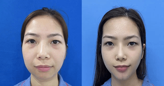 Sửa cằm vẹo, lỗi do phẫu thuật