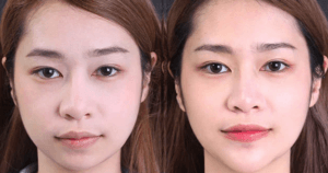 Sửa cằm vẹo, lỗi do phẫu thuật