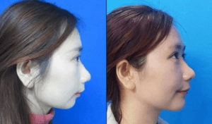 Sửa cằm vẹo, lỗi do phẫu thuật
