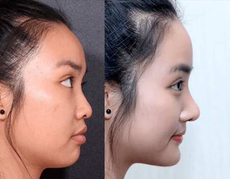 Độn cằm V-line