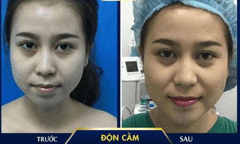 Độn cằm V-line