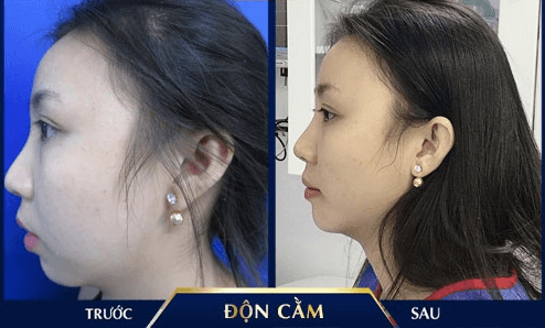 Độn cằm V-line