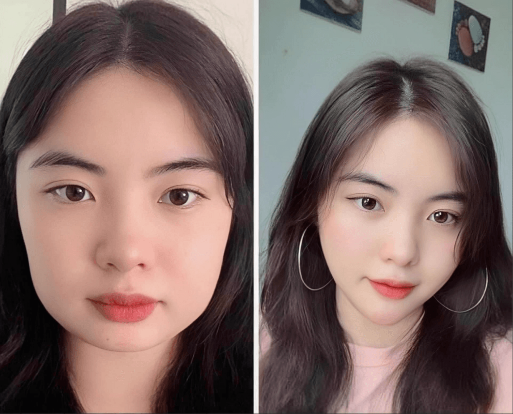 Độn cằm V-line