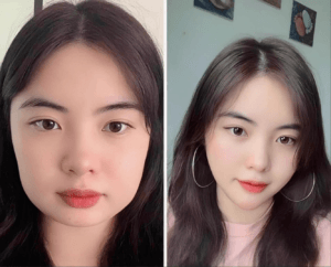 Độn cằm V-line