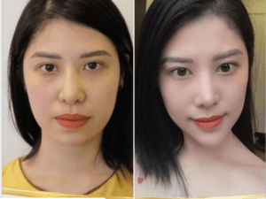 Độn cằm V-line