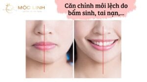 Căn chỉnh môi lệch do bẩm sinh, tai nạn,…