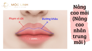 Nâng cao môi (Nâng cao nhân trung môi)