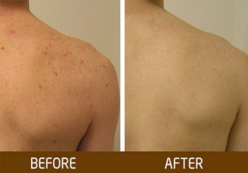 Điều trị viêm nang lông tại Thẩm Mỹ Mộc Linh Hải Phòng
