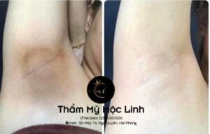 Cách Trị Thâm Nách Đơn Giản, Hiệu Quả Và Nhanh Chóng