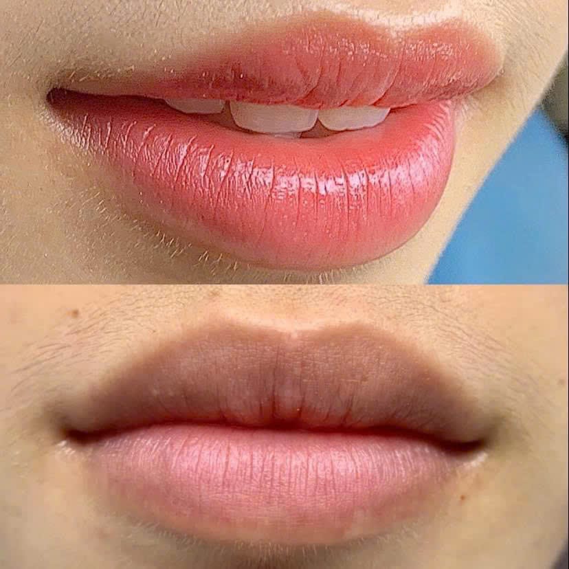 Khử Thâm Môi, Giúp Môi Hồng Hào Tự Nhiên