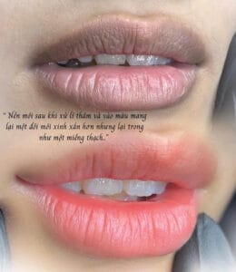 Khử Thâm Môi, Giúp Môi Hồng Hào Tự Nhiên