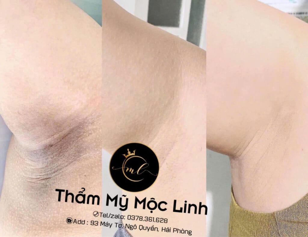 Cách Trị Thâm Nách Đơn Giản, Hiệu Quả Và Nhanh Chóng