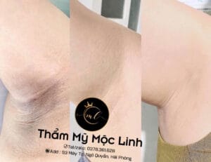 Cách Trị Thâm Nách Đơn Giản, Hiệu Quả Và Nhanh Chóng