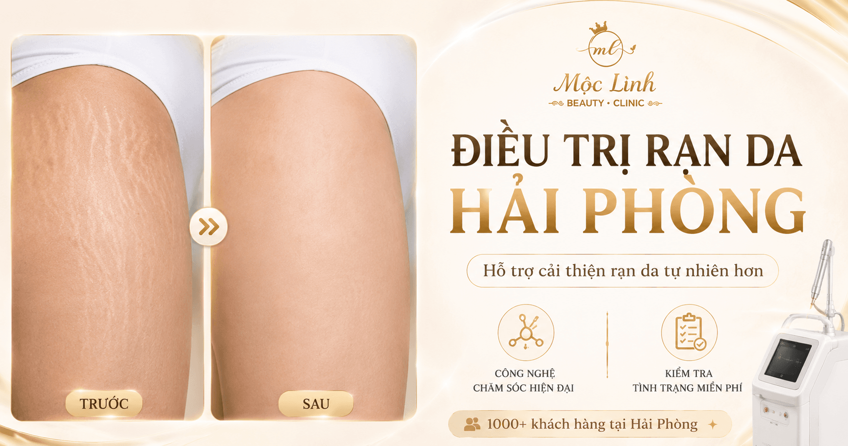 Điều Trị Rạn Da