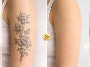 Xoá hình xăm Hải Phòng