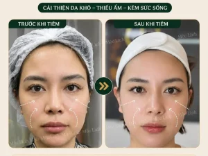 Tiêm BAP Uy Tín Hải Phòng