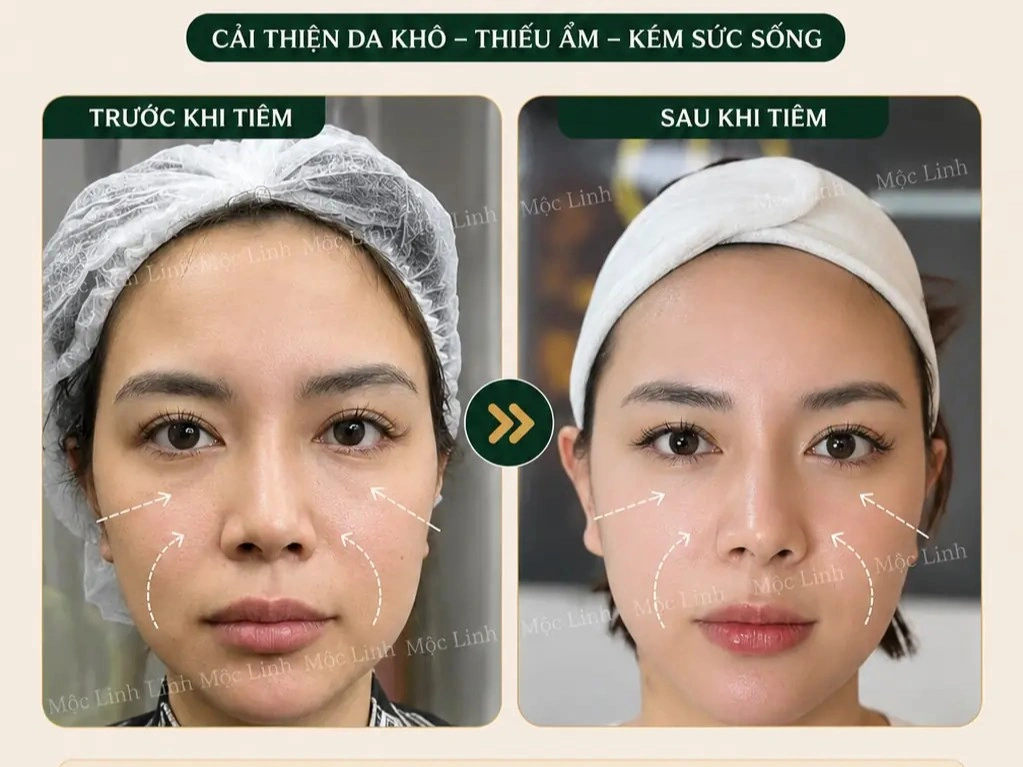Tiêm BAP Uy Tín Hải Phòng