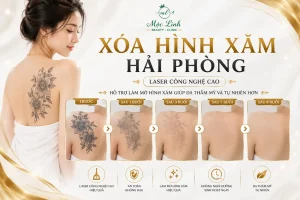 Xoá hình xăm Hải Phòng