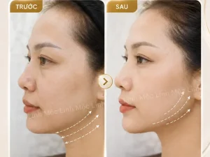 Nâng cơ táo (Căng chỉ) uy tín tại Hải Phòng
