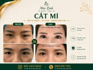 Cắt Mí Mắt Thẩm Mỹ Hải Phòng