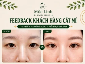 Cắt Mí Mắt Thẩm Mỹ Hải Phòng