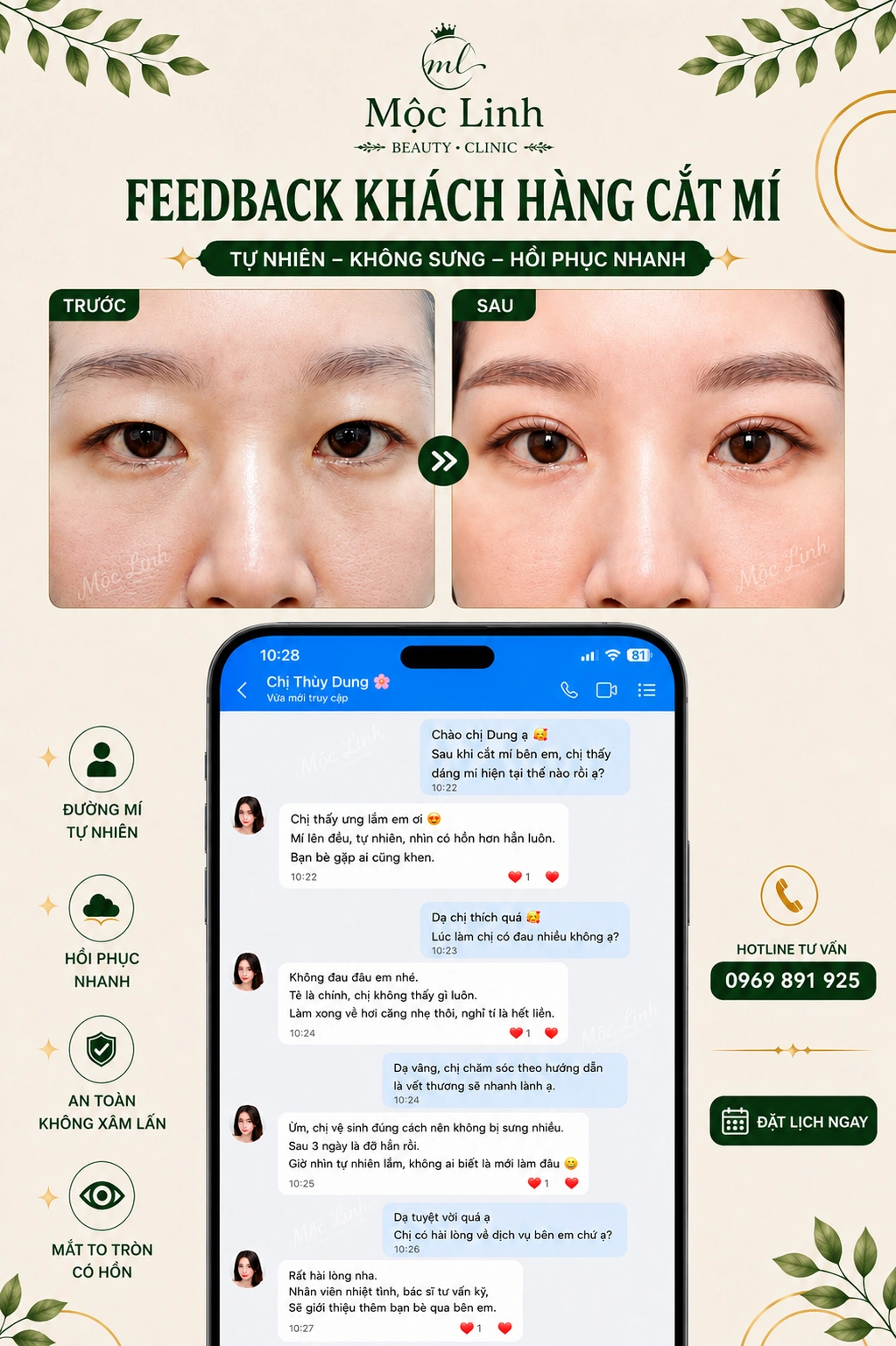 Khách hàng cắt mí mắt tại Thẩm Mỹ Mộc Linh Hải Phòng