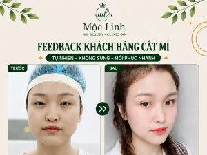 Cắt Mí Mắt Thẩm Mỹ Hải Phòng