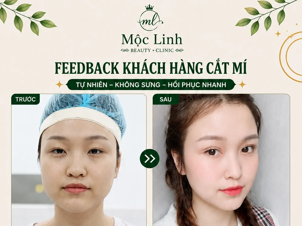 Cắt Mí Mắt Thẩm Mỹ Hải Phòng