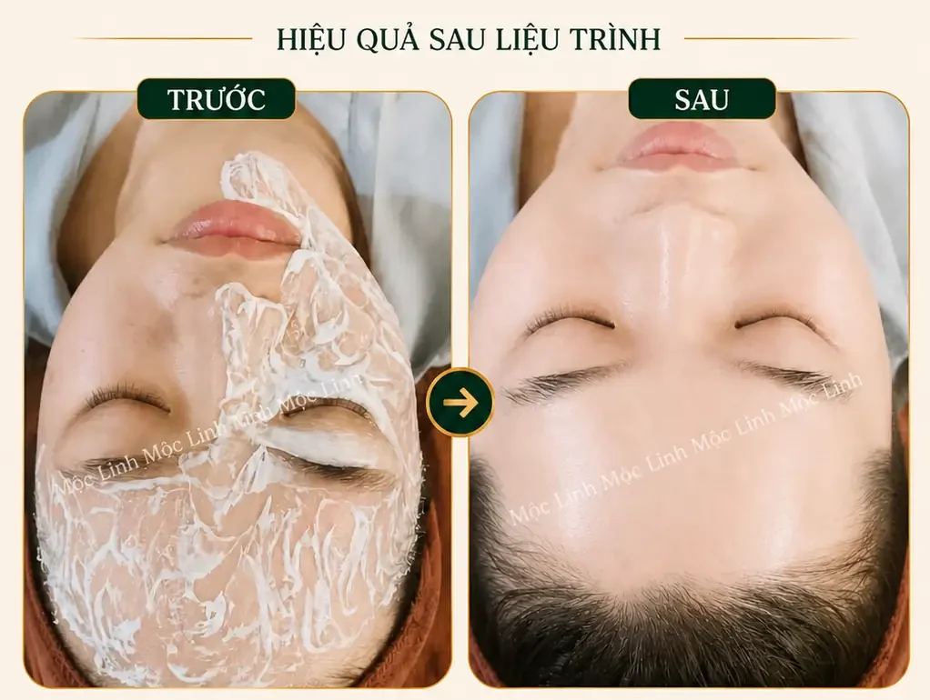 Cấy trắng da Hải Phòng
