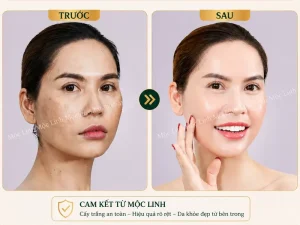 Cấy trắng da Hải Phòng