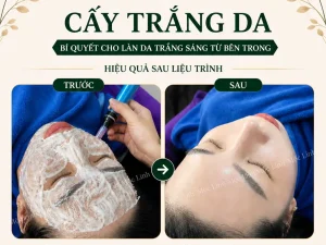 Cấy trắng da Hải Phòng