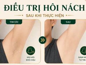 Trị hôi nách Hải Phòng