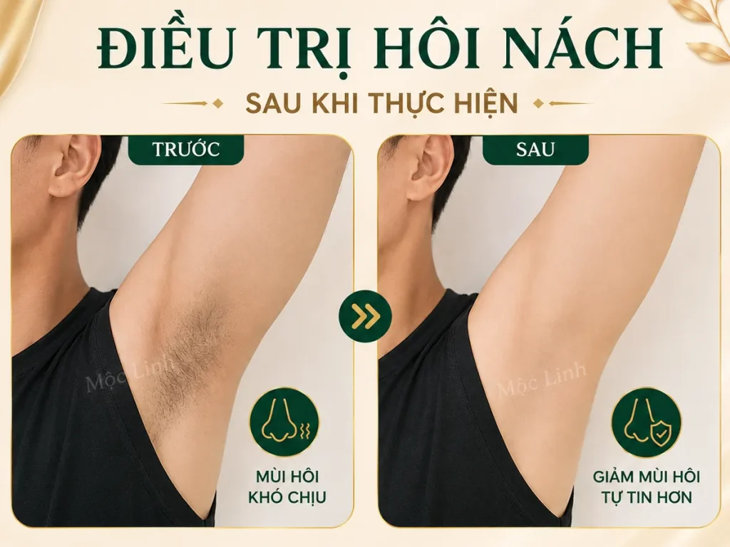 Trị hôi nách Hải Phòng