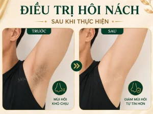 Trị hôi nách Hải Phòng