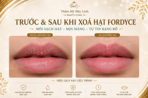 Xoá hạt Fordyce Hải Phòng