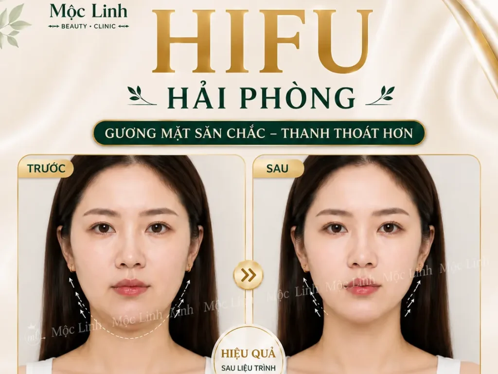 Nâng cơ công nghệ Hifu hiện đại bậc nhất