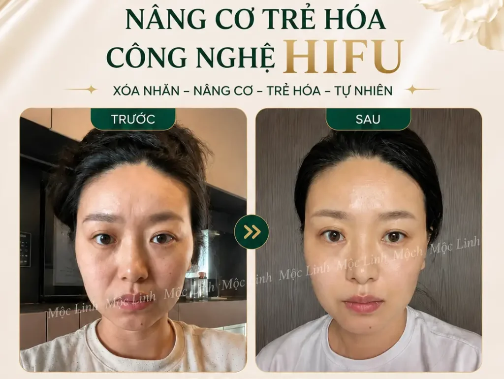 Nâng cơ công nghệ Hifu hiện đại bậc nhất