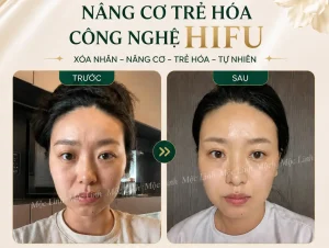 Nâng cơ công nghệ Hifu hiện đại bậc nhất