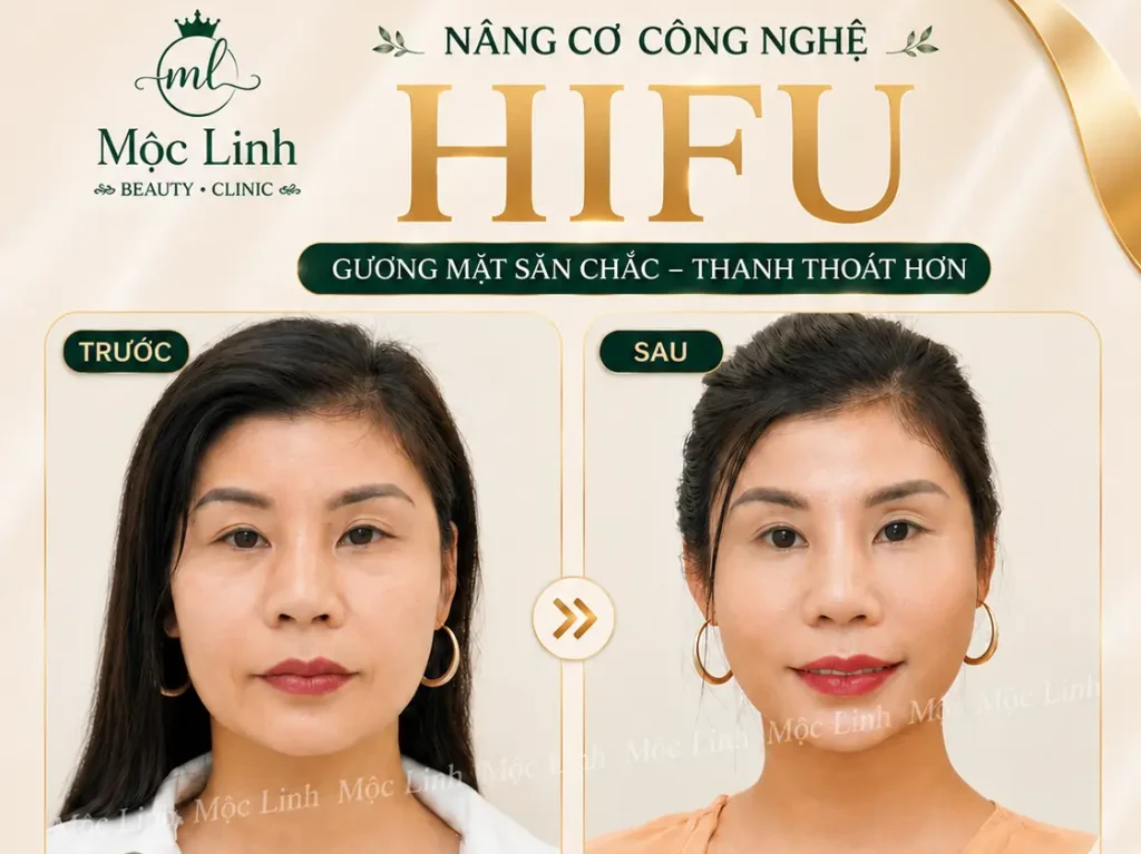 Nâng cơ công nghệ Hifu hiện đại bậc nhất