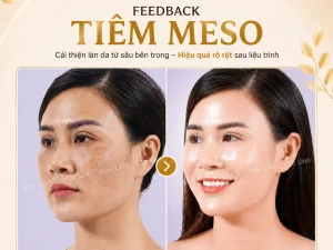 Tiêm Meso Máy An Toàn Uy Tín Hải Phòng
