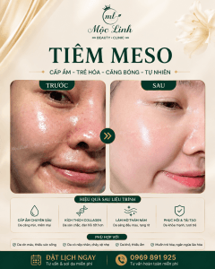 Tiêm Meso Hải Phòng