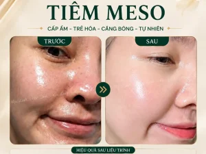 Tiêm Meso Máy An Toàn Uy Tín Hải Phòng