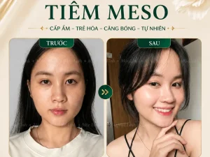 Tiêm Meso Máy An Toàn Uy Tín Hải Phòng