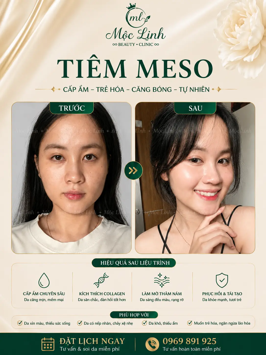 Hình ảnh dịch vụ tiêm meso tại Hải Phòng